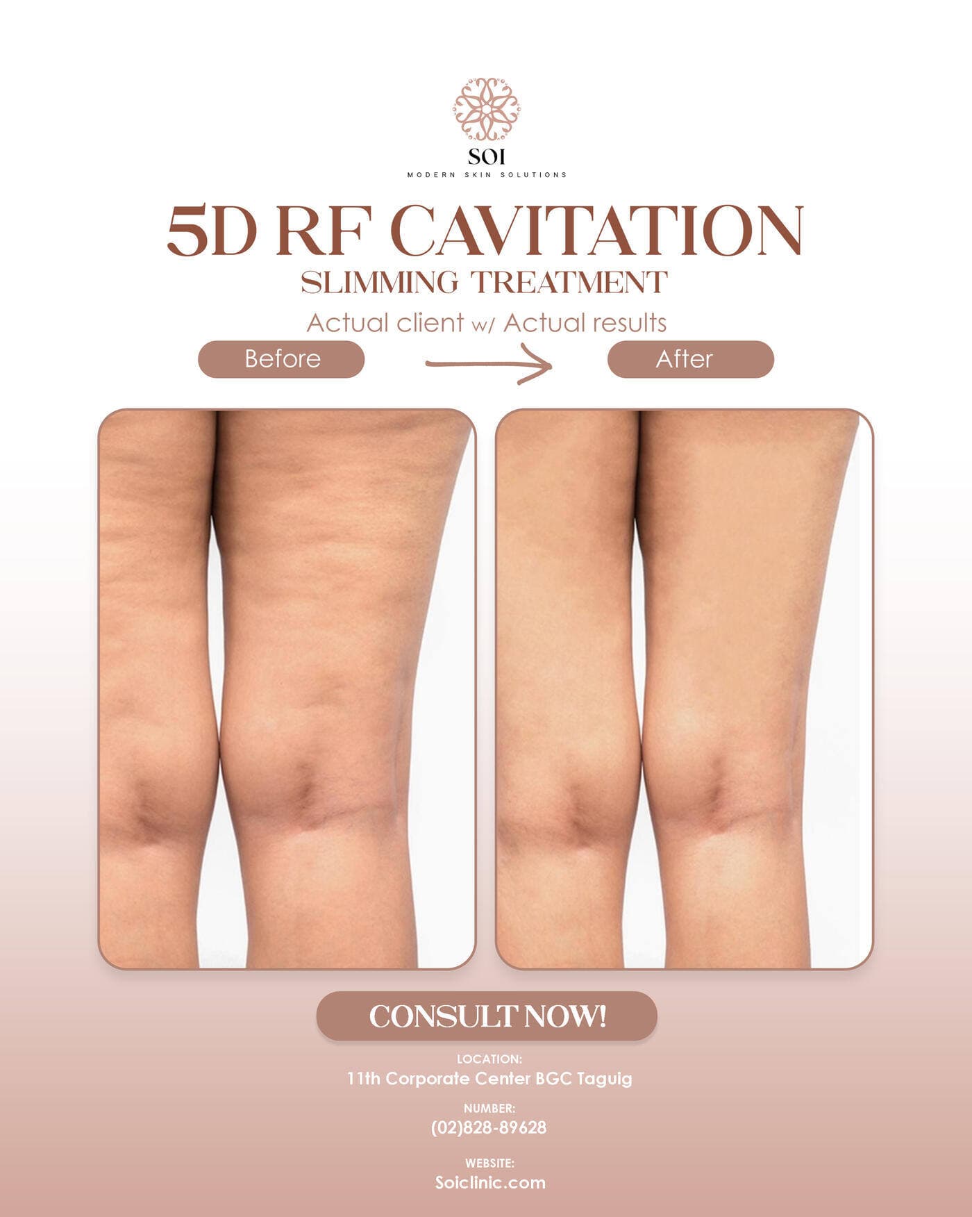 5D Cavitation before and after result