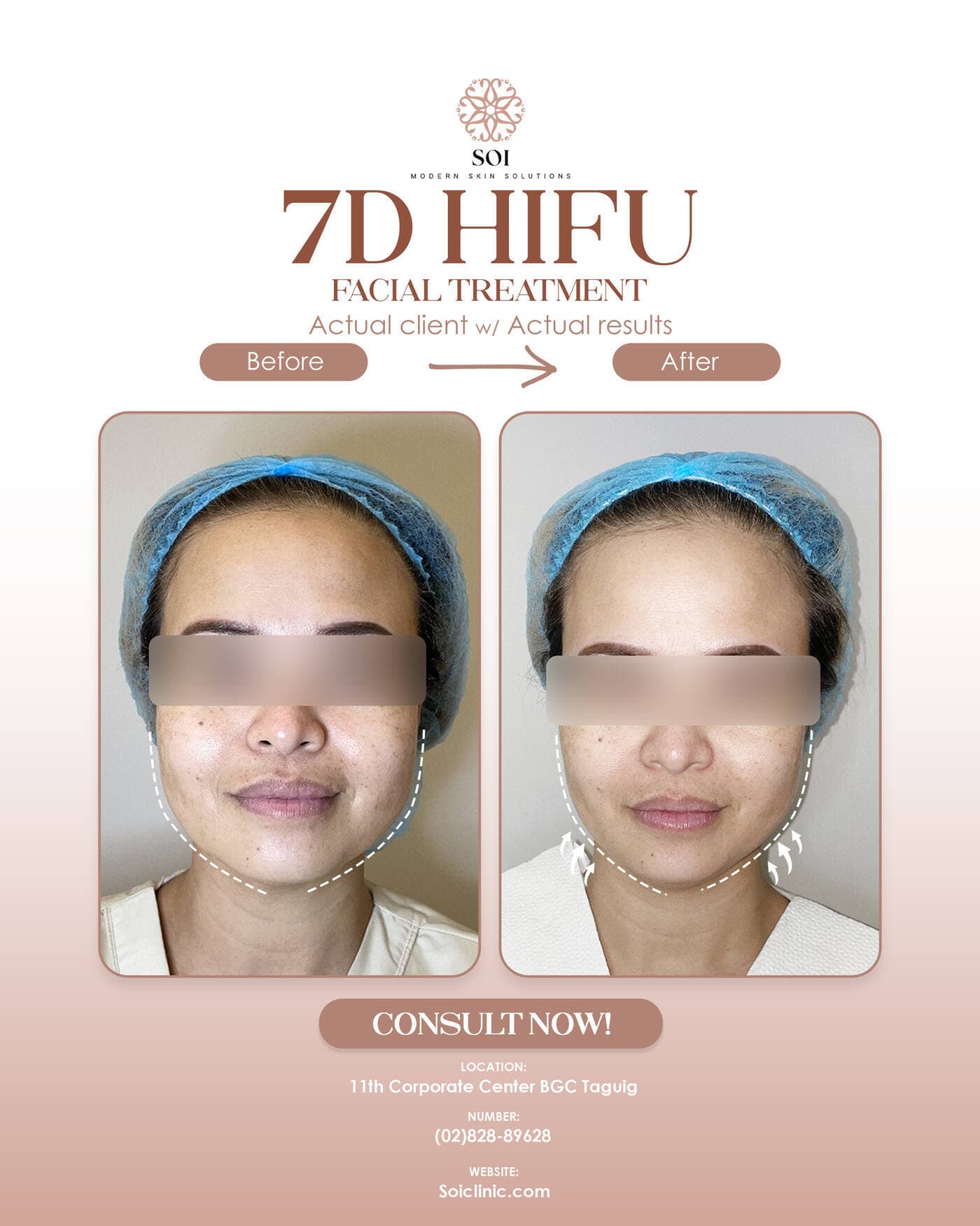 7D HIFU before and after result