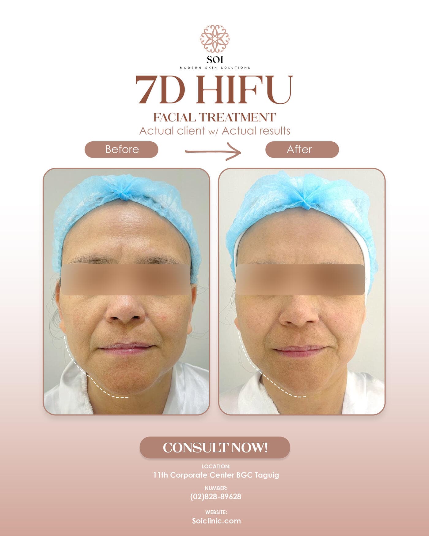 7D HIFU II before and after result