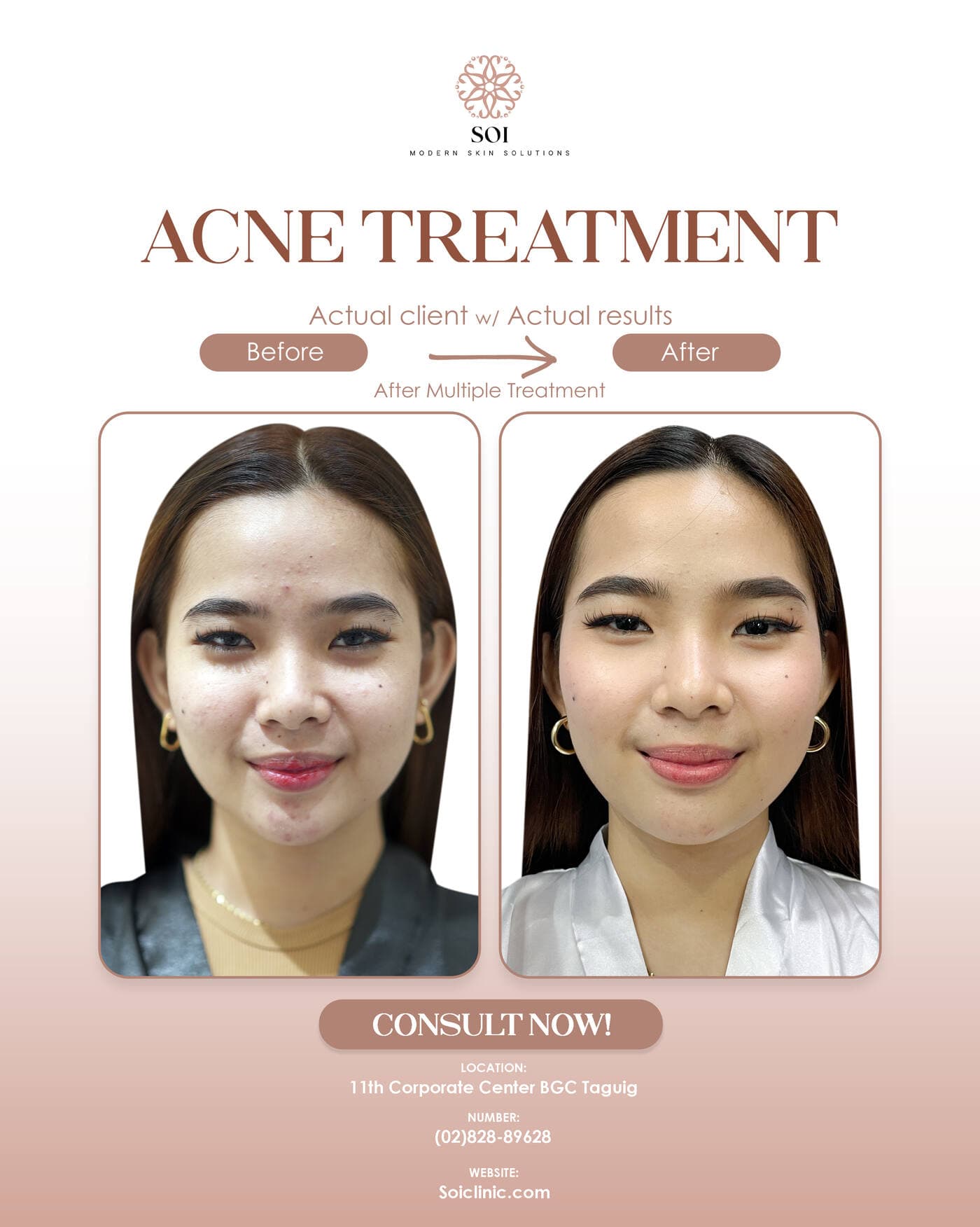 Acne Treatment before and after result