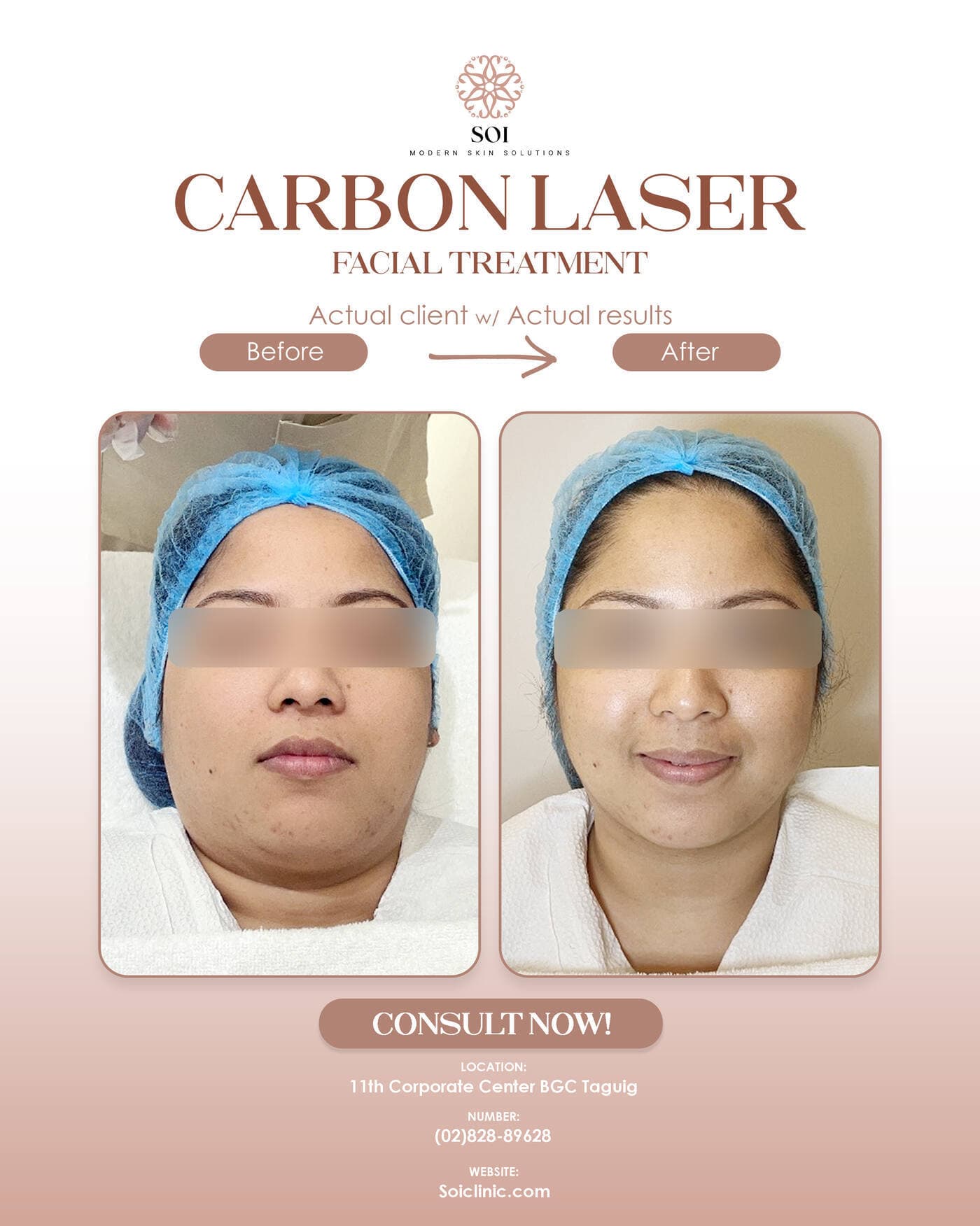 Carbon Laser before and after result