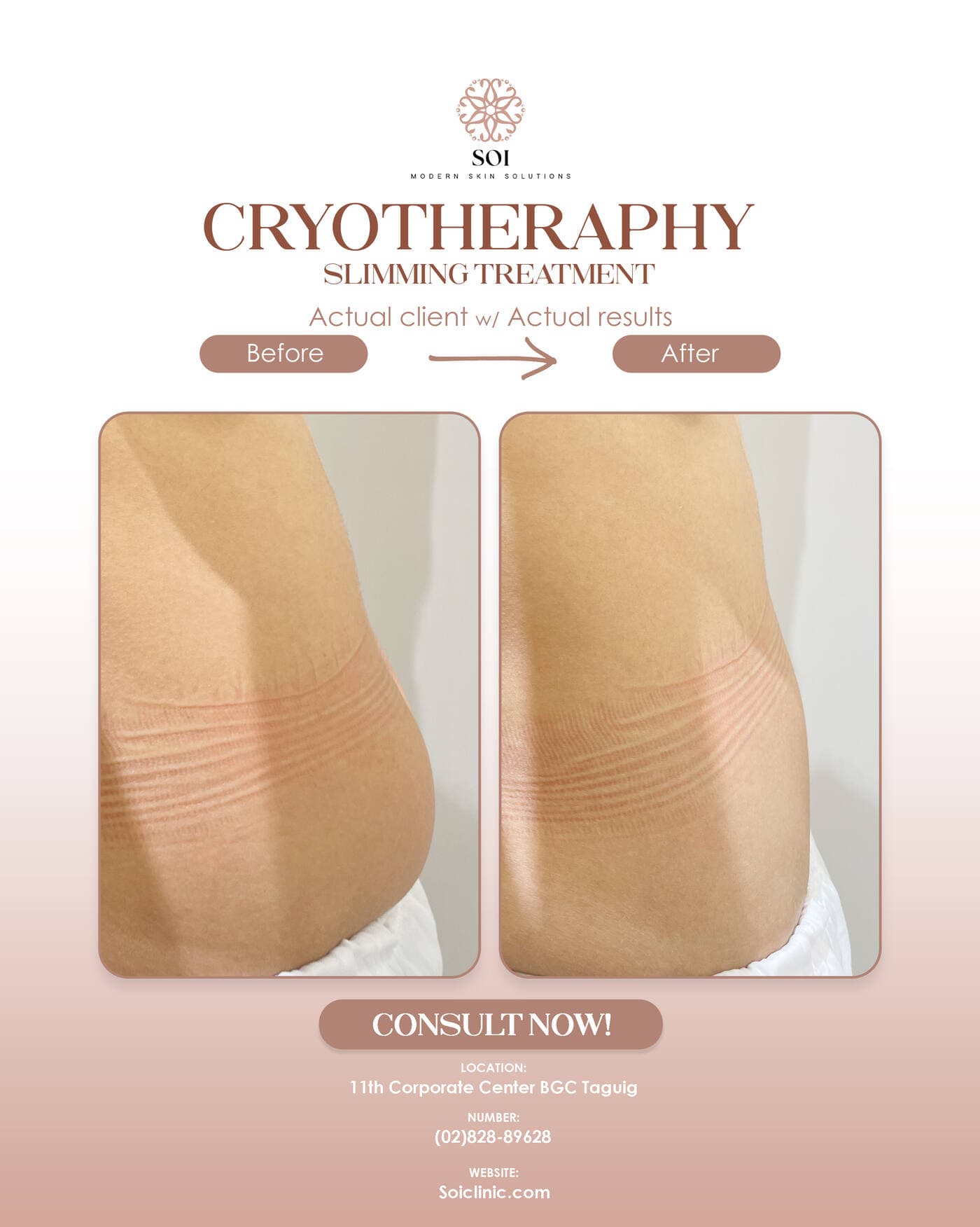 Cryotherapy before and after result