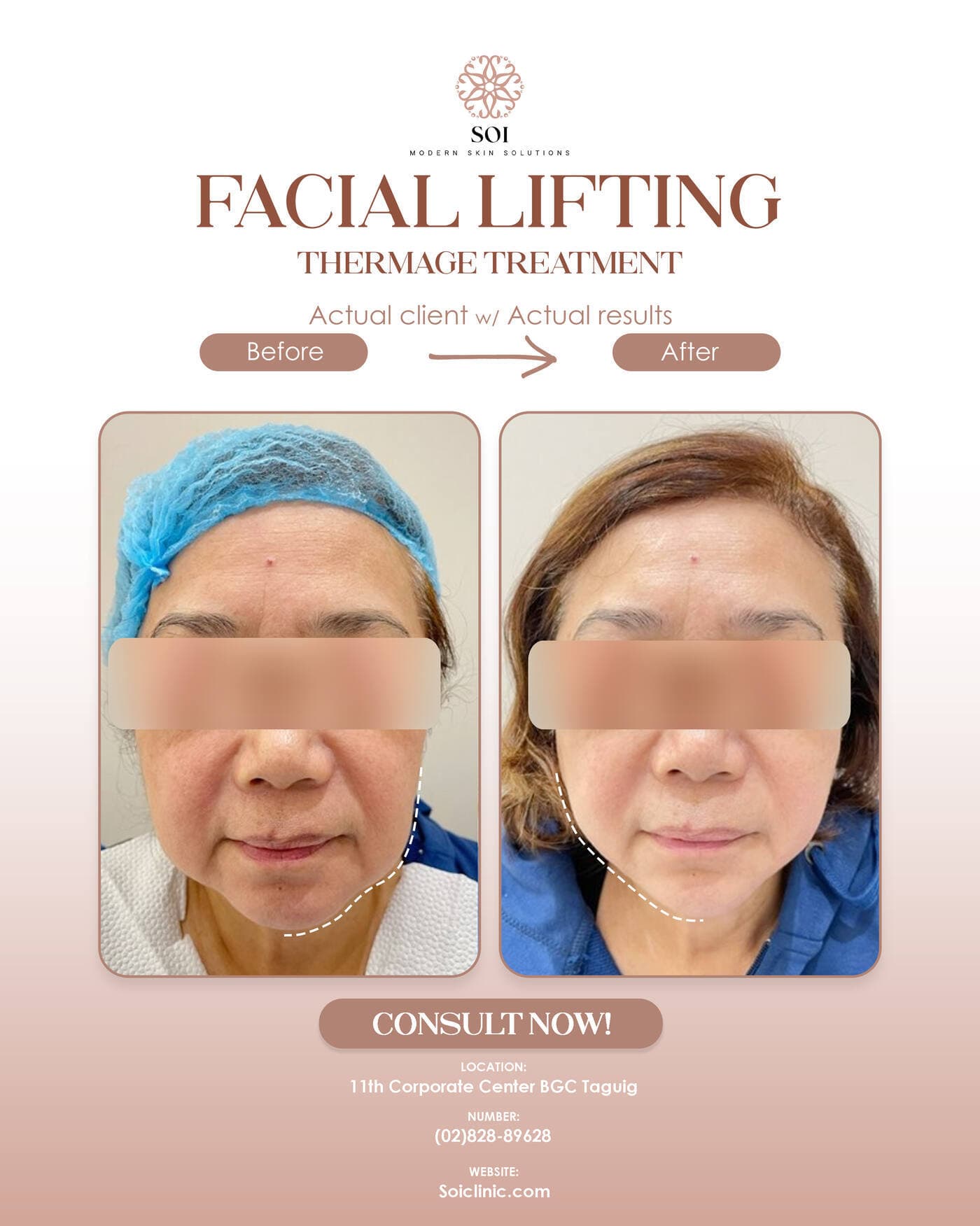 Facial Lifting before and after result
