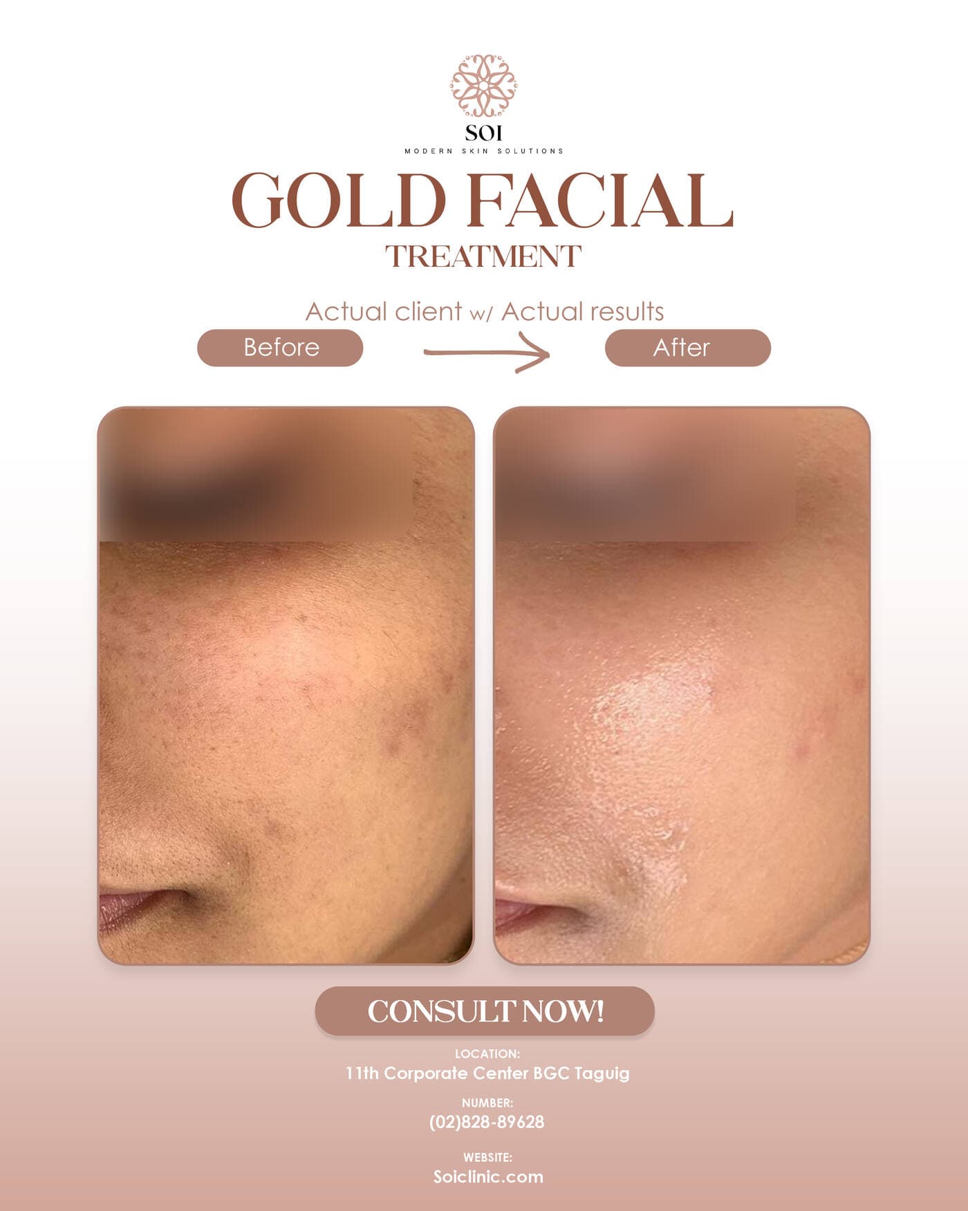 Gold Facial before and after result