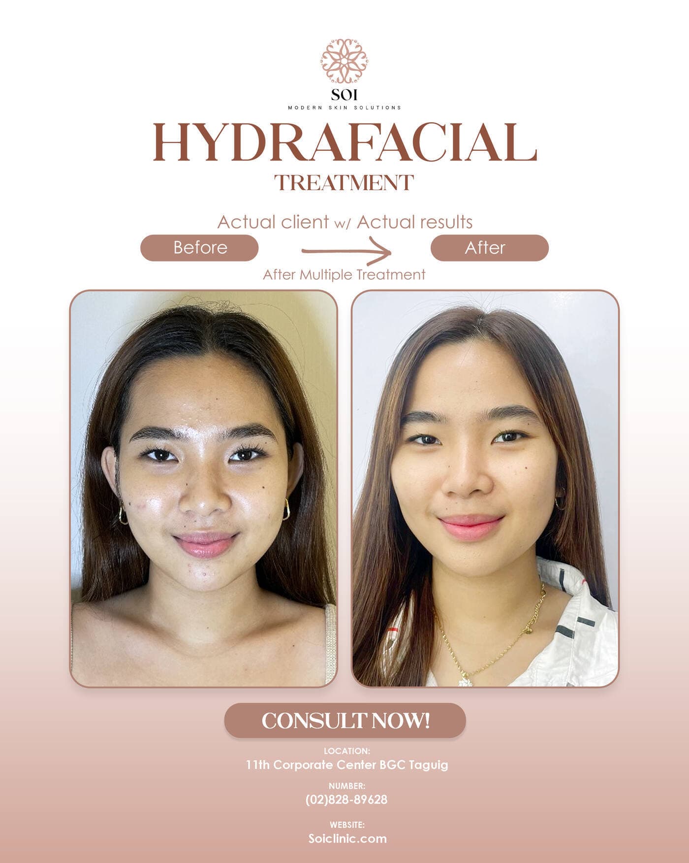 HydroFacial before and after results at SOI Clinic, Manila