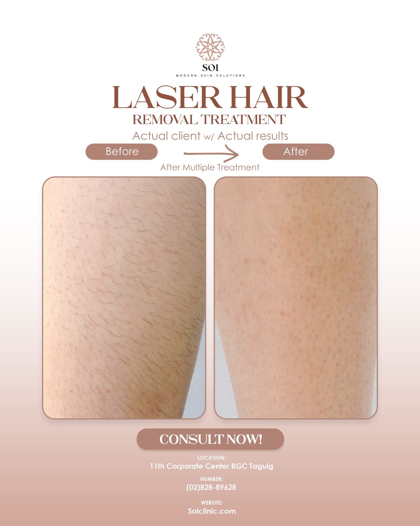 Laser Hair III before and after result