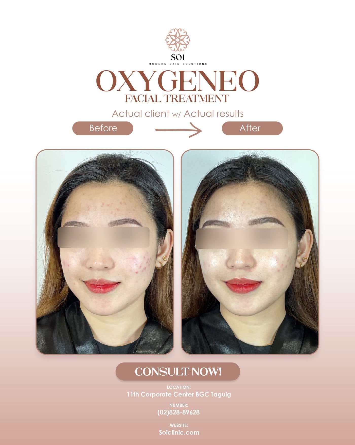 Oxygen Facial II before and after results at SOI Clinic, Manila