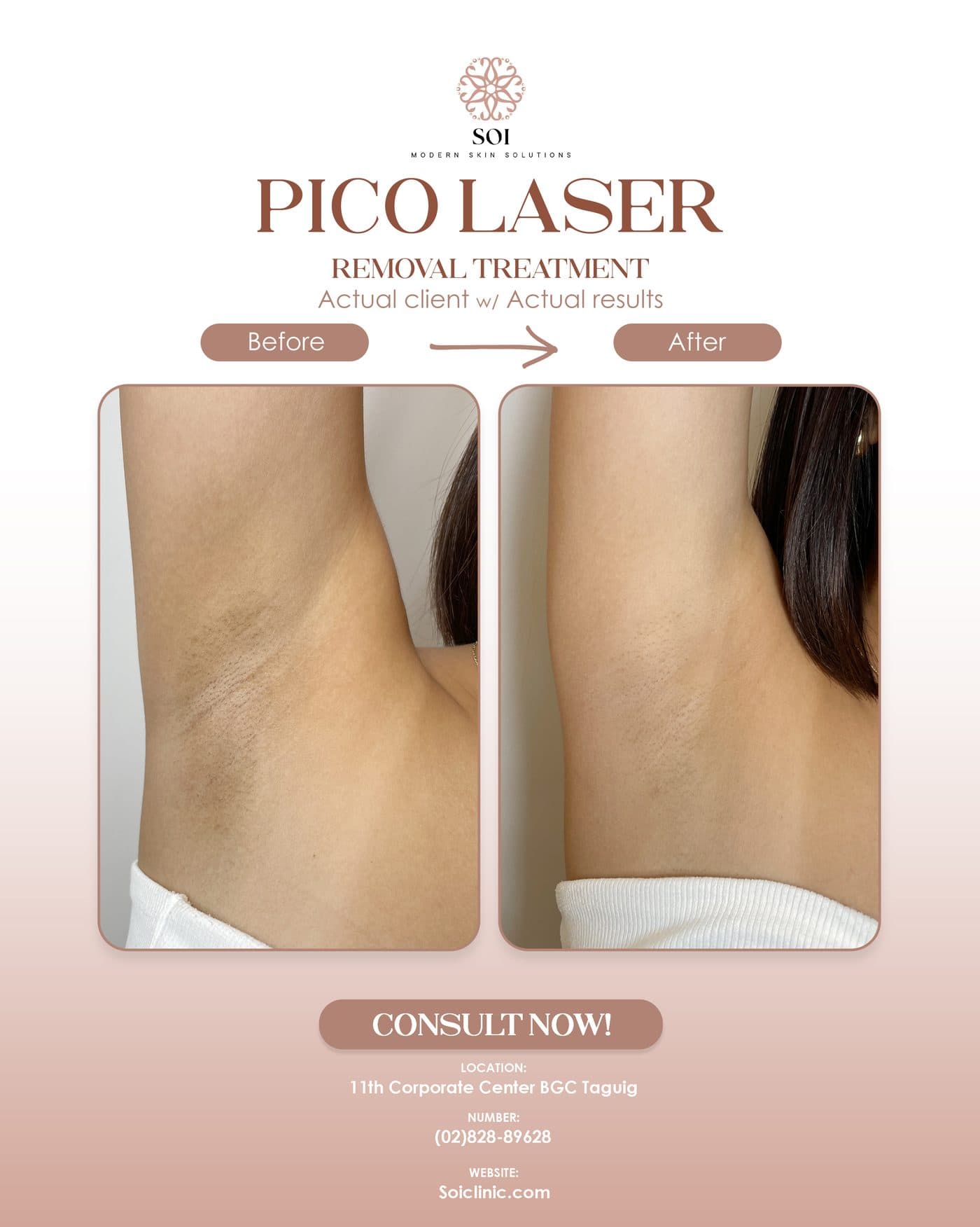 Pico Laser before and after result