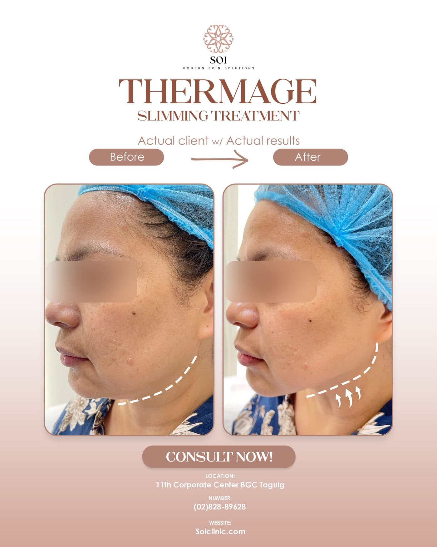 Ultra Tightening before and after results at SOI Clinic, Manila