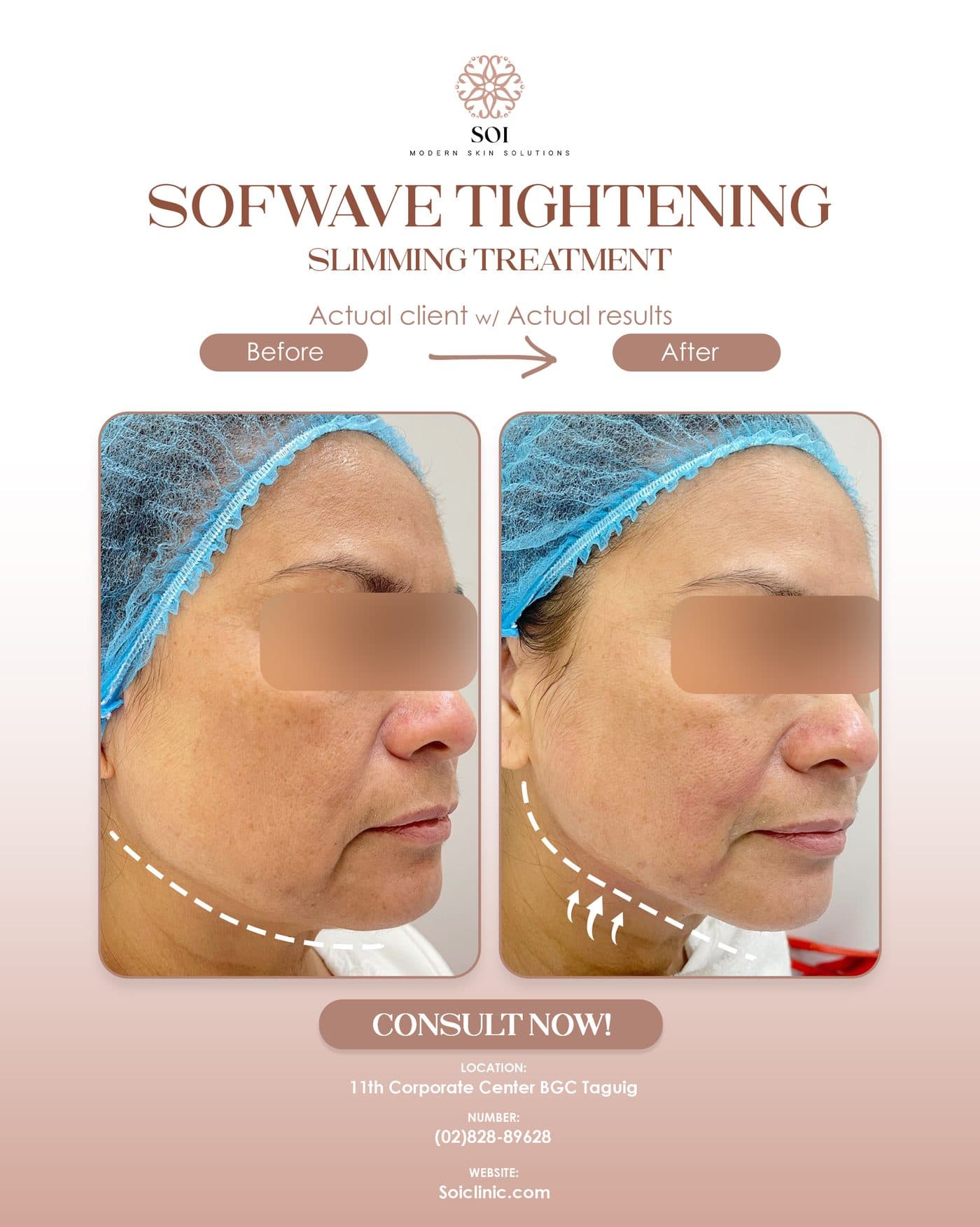 Ultrasound Lifting before and after results at SOI Clinic, Manila