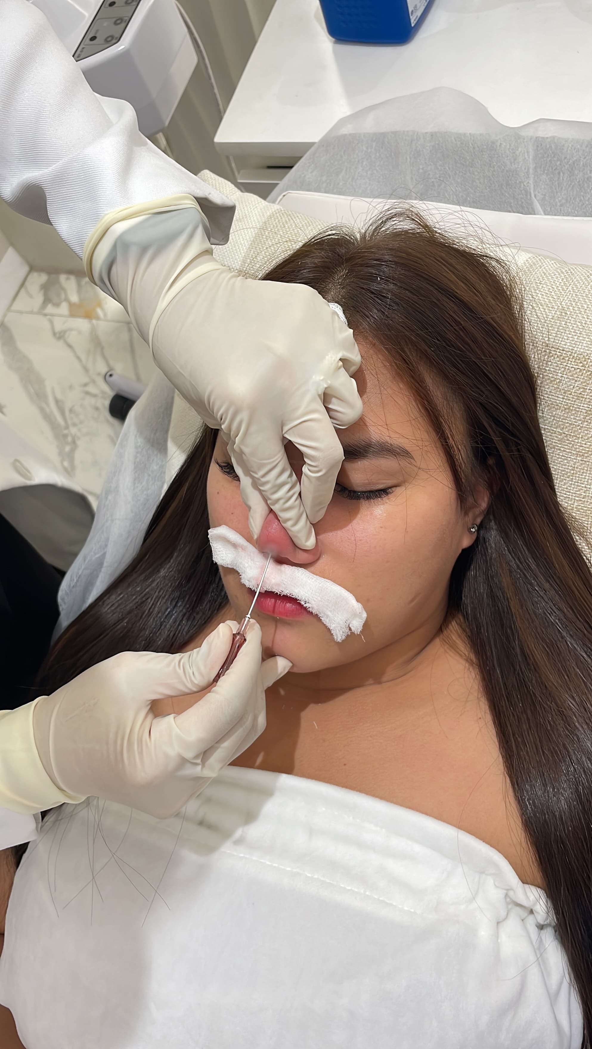Hiko Nose Thread treatment at SOI Clinic