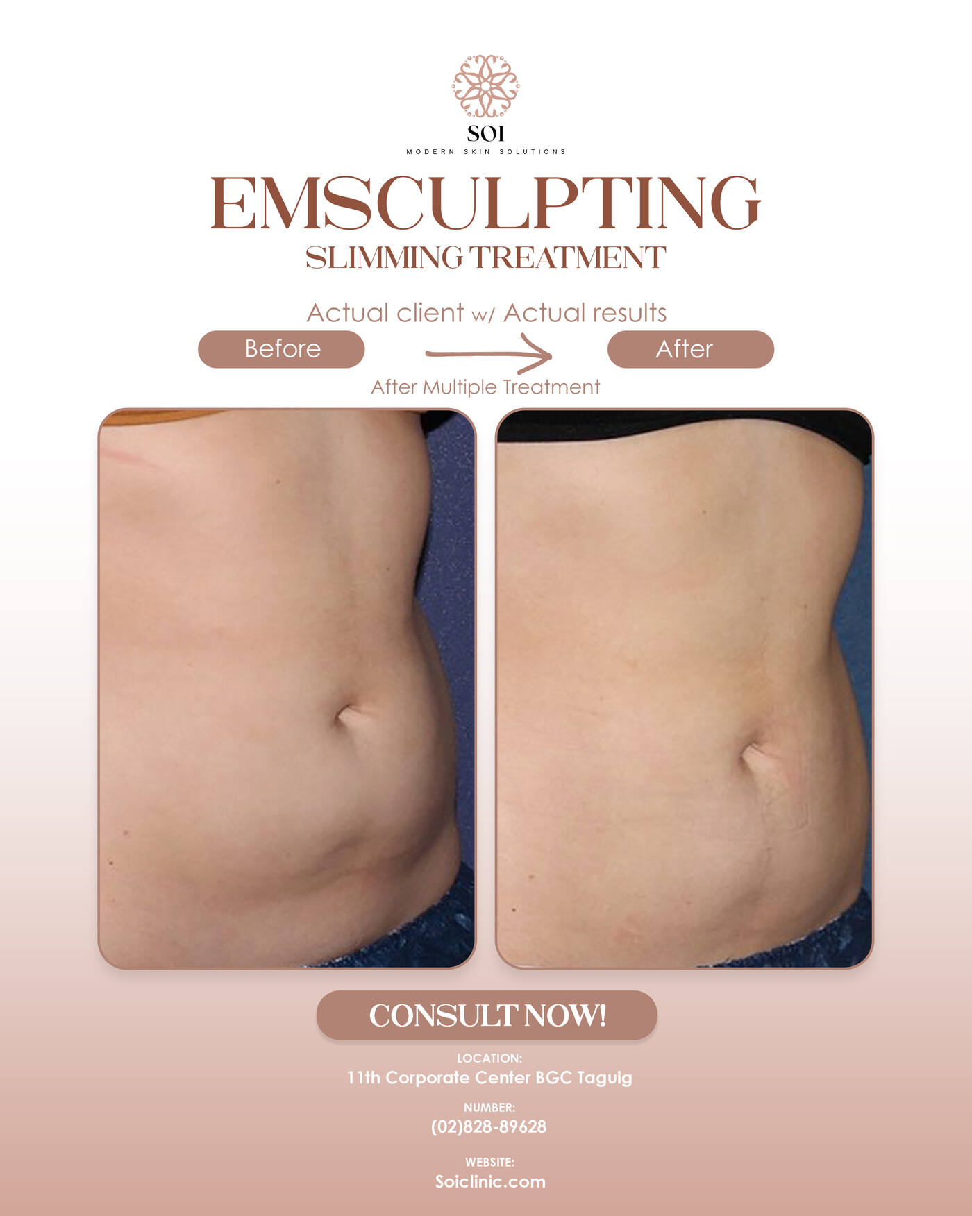 Before and after ab toning treatment at SOI Clinic
