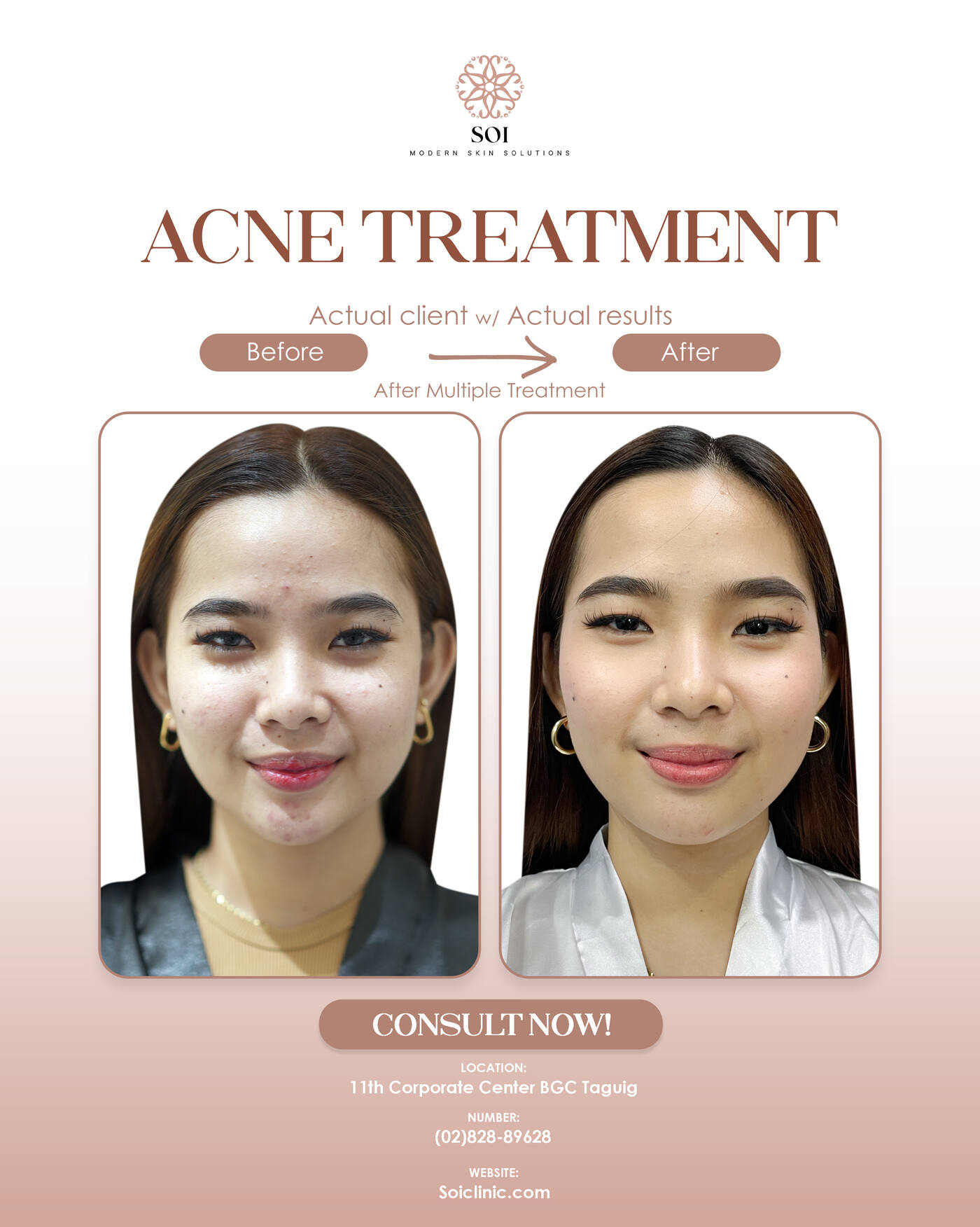 Before and after acne treatment at SOI Clinic