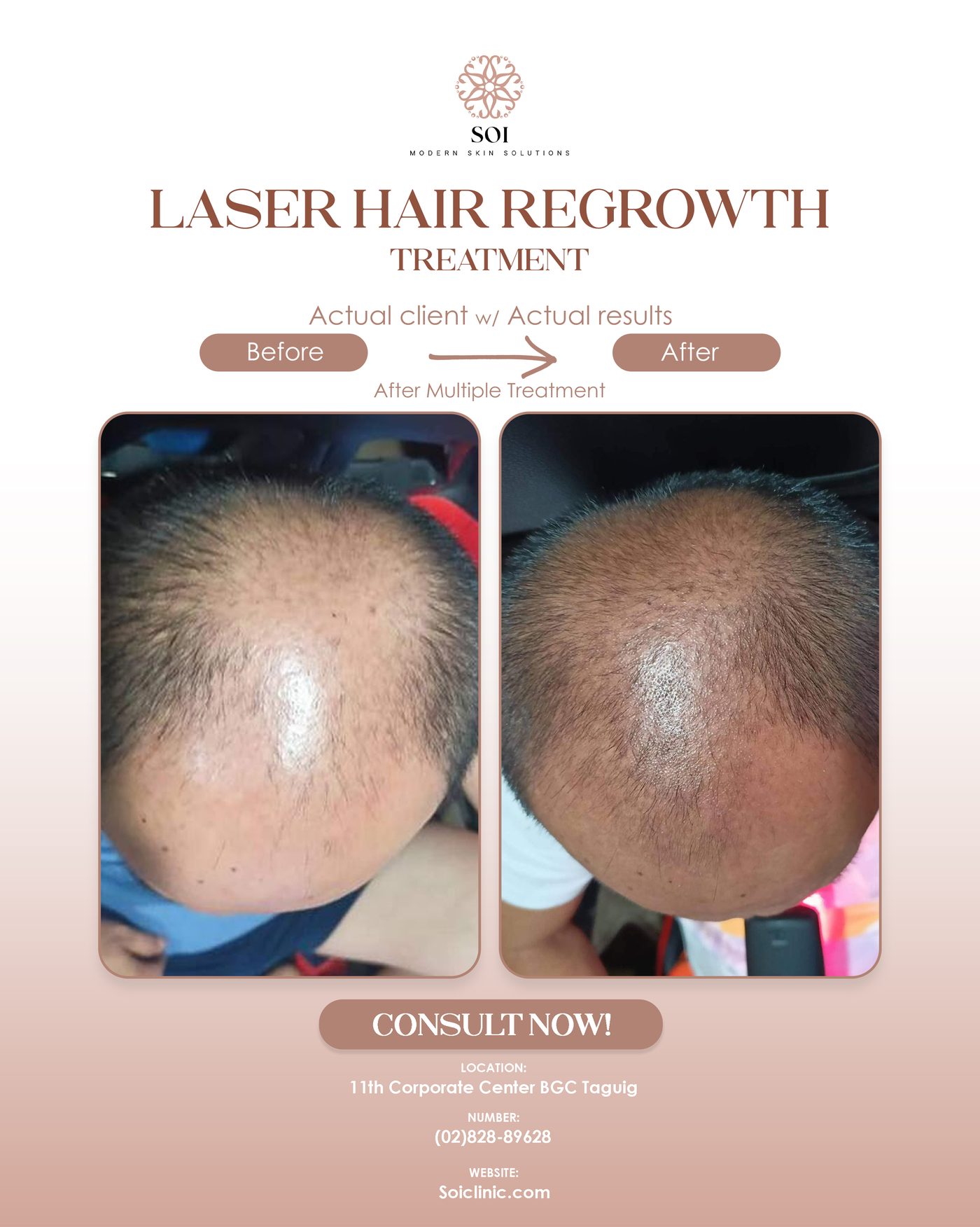 Before and after laser hair regrowth treatment at SOI Clinic