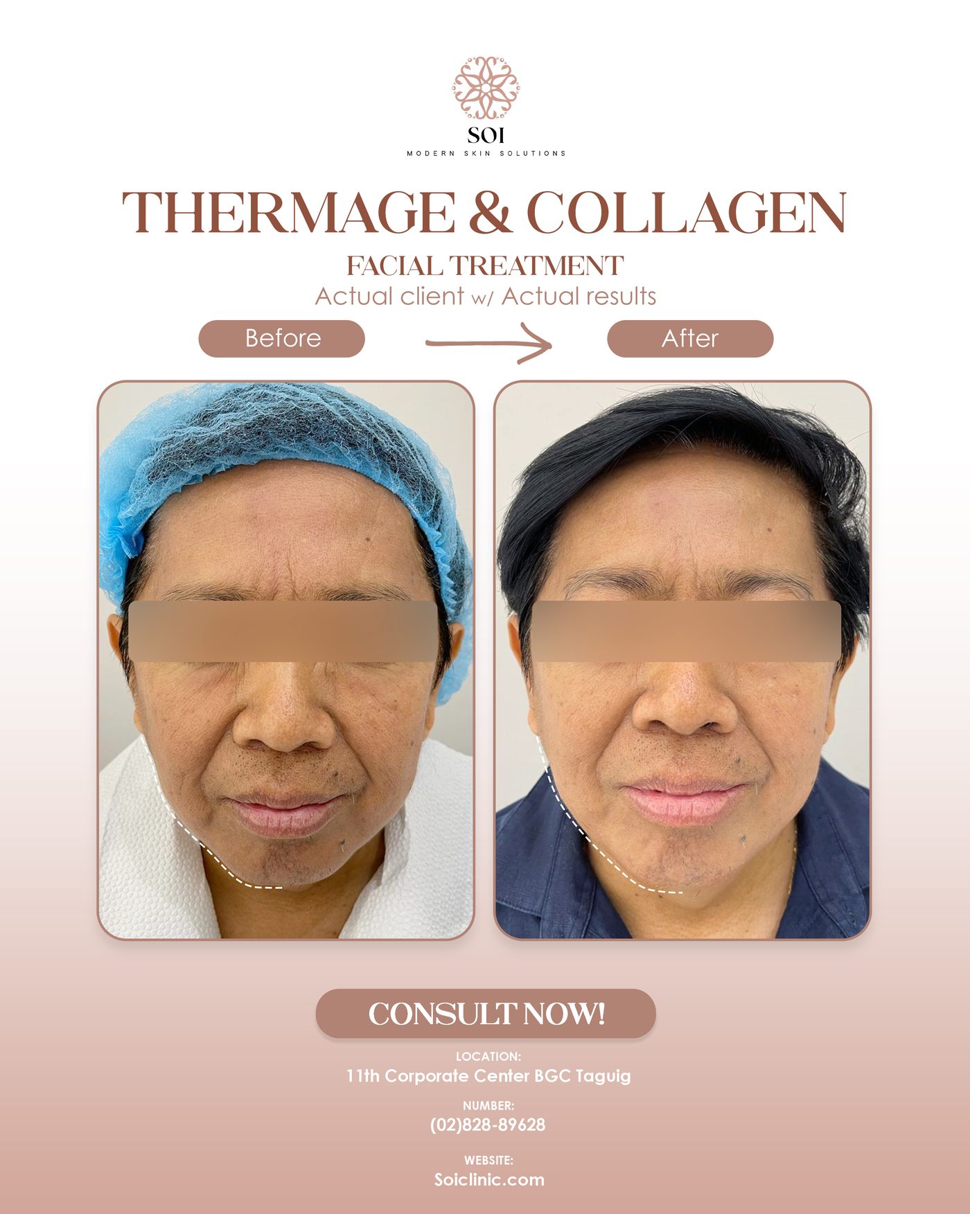Before and after tightening and collagen treatment at SOI Clinic